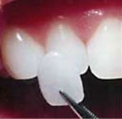 example of how thin a porcelain veneer is