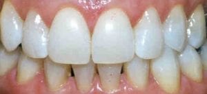 photo-of-teeth-whitening-after-treatment