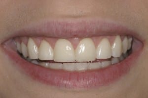 Barrington-tooth-bonding-after-treatment