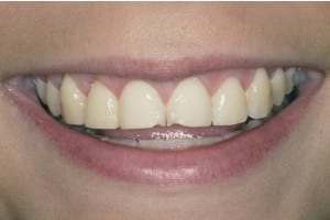 Barrington-tooth-bonding-before-treatment
