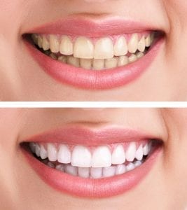 results with professional teeth whitening