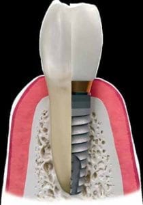 diagram of a dental implant placement