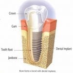 Diagram of each dental implant component