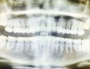 panoramic xray from Miley Cyrus