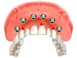 diagram demonstrating how a denture can be placed over dental implants