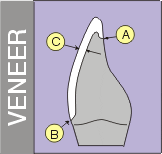 diagram of tooth and porcelain veneer