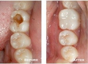 closeup of a cavity on a molar and the final product after the filling