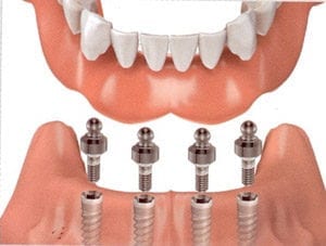 diagram of dental appliance placed on dental implants