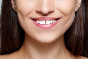 image of a woman smiling with a gap between two front teeth