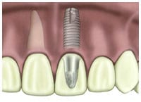 close-up graphic of a single dental implant