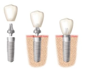diagram of how a crown fits onto a dental implant