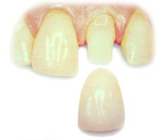 image that shows how a porcelain crown fits on the tooth