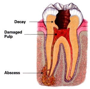 Diagram of the inside of a tooth
