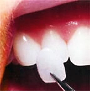 close up image of a porcelain veneer behing applied to natural tooth