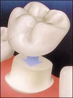 diagram of how a porcelain crown fits on a tooth