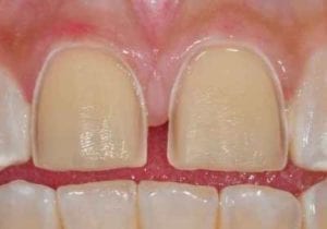 image of two front teeth that have been prepared for porcelain veneers