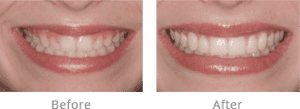 before and after image of a patient with porcelain veneers