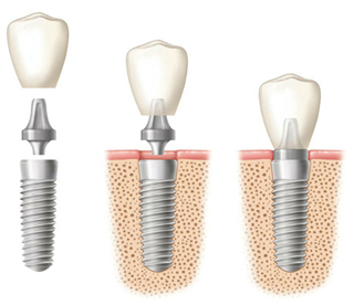 Diagram of dental implant components before and after placement in the bone