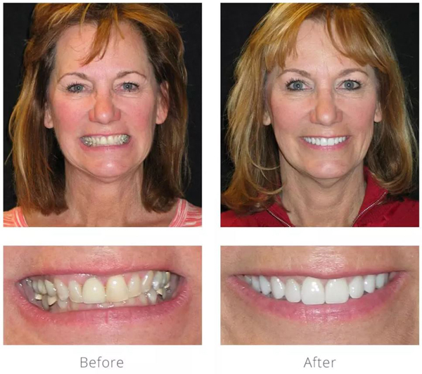 Before and after smile gallery photos from Barrington cosmetic dentist Dr. Gavrilos
