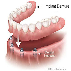 A denture hovering above four dental implants in the lower jawbone