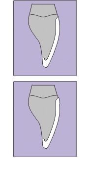 Diagram of a smooth porcelain veneers vs a veneer with an overhang