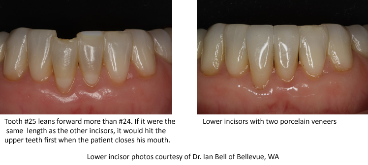 Chipped lower incisor before and after photos